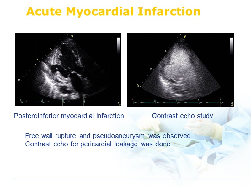 Acute Myocardial Infarction Posteroinferior myocardial infarction Contrast echo study Free wall rupture and pseudoaneurysm